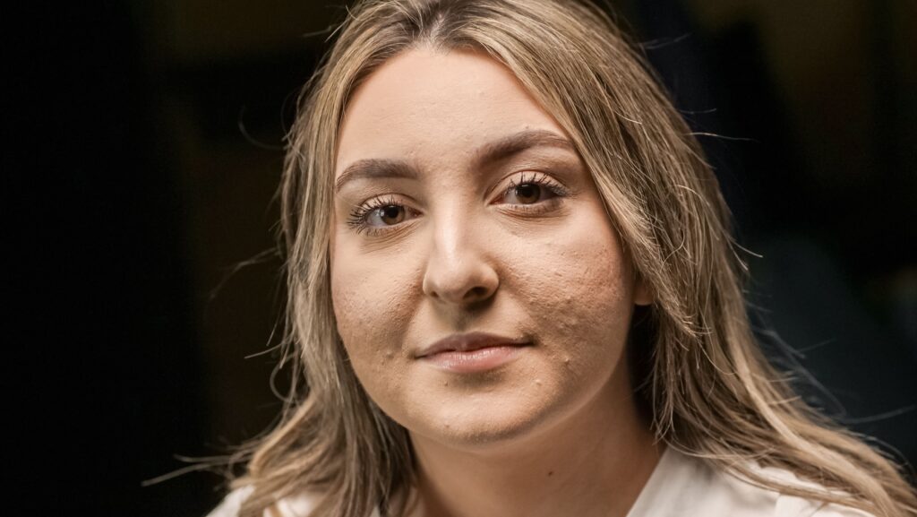 melasma ou manchas de sol na pele madura