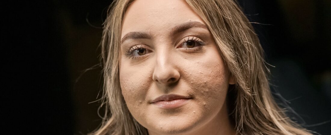 Melasma, Lentigo Solar ou Sardas? Como Diferenciar as Manchas na Pele Madura