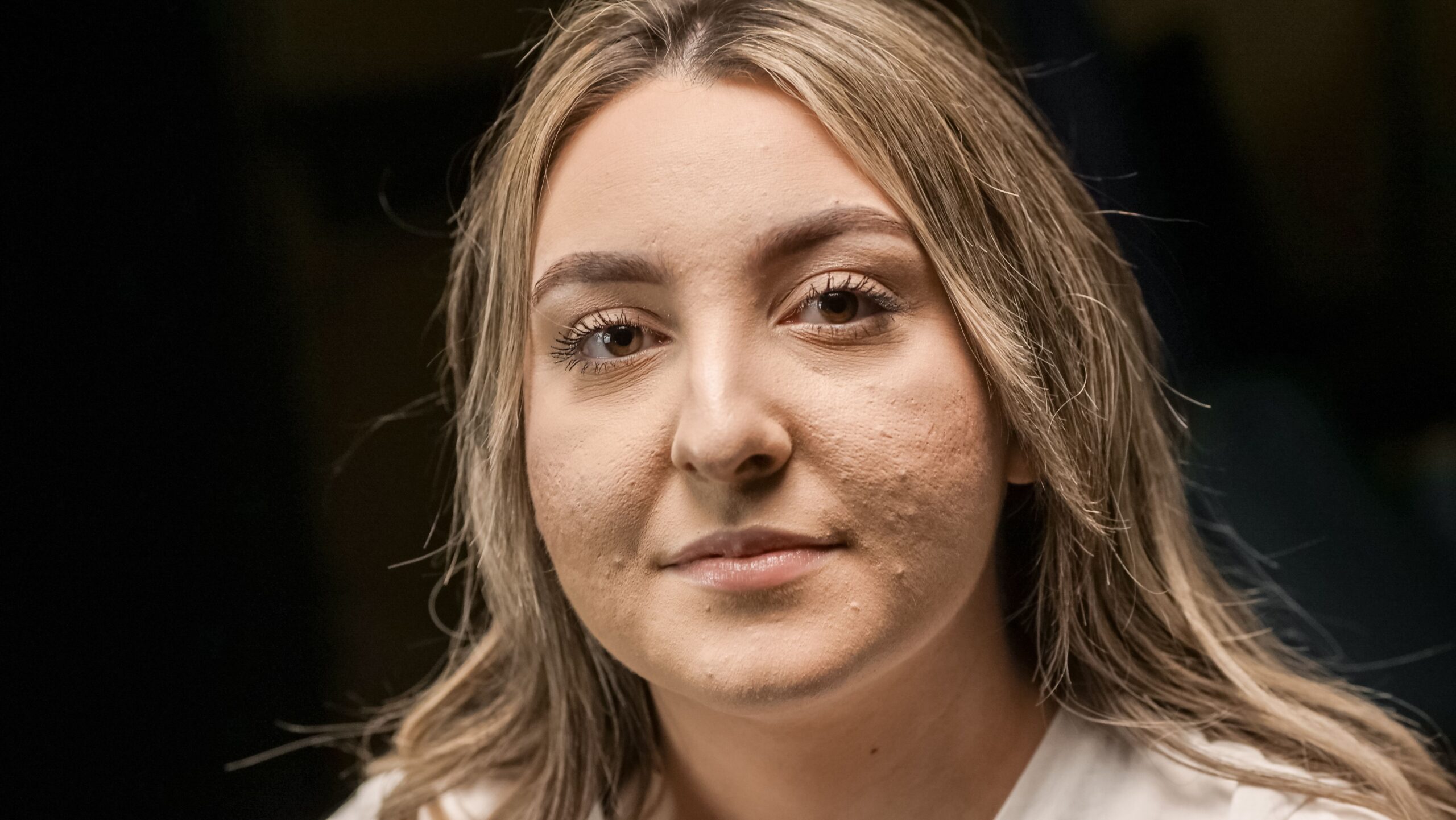 melasma ou manchas de sol na pele madura