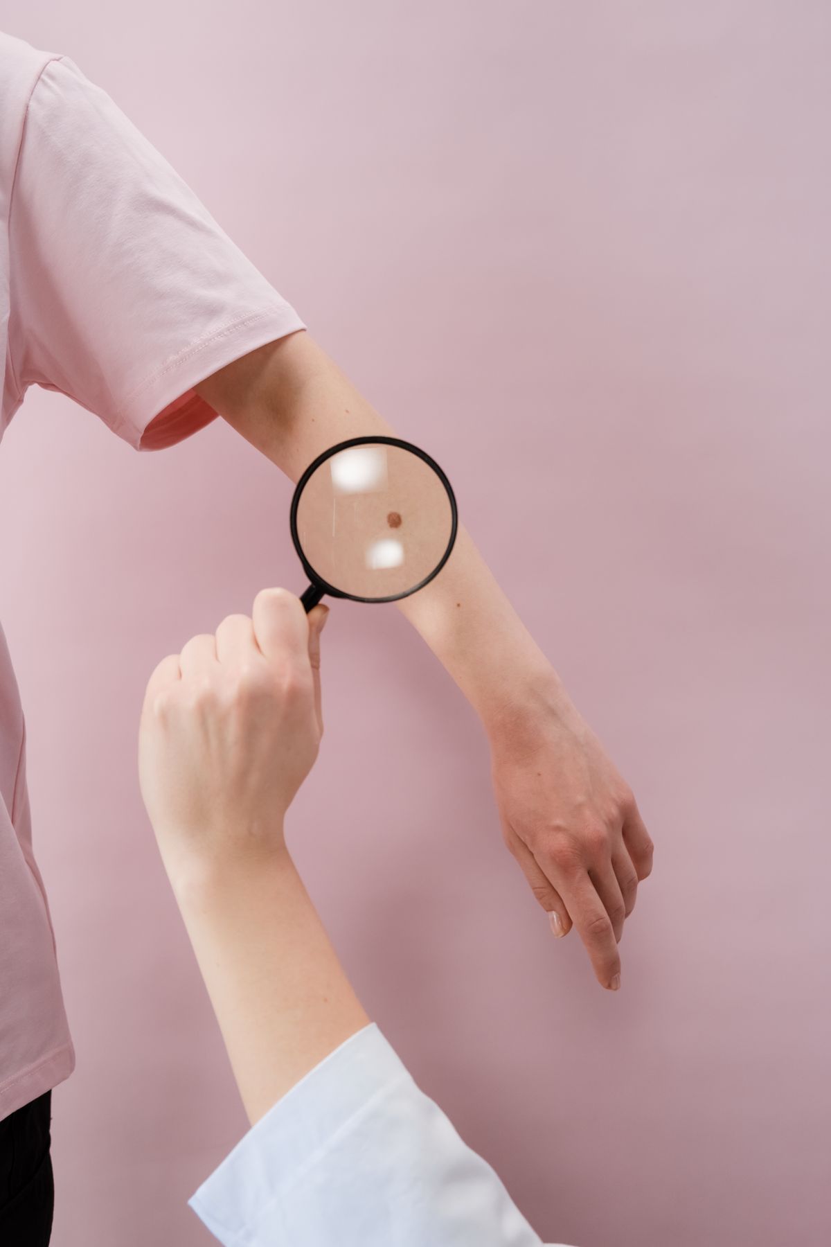 Lupa mostrando manchas na pele do braço, ilustrando diferenciação de manchas de acne e melasma