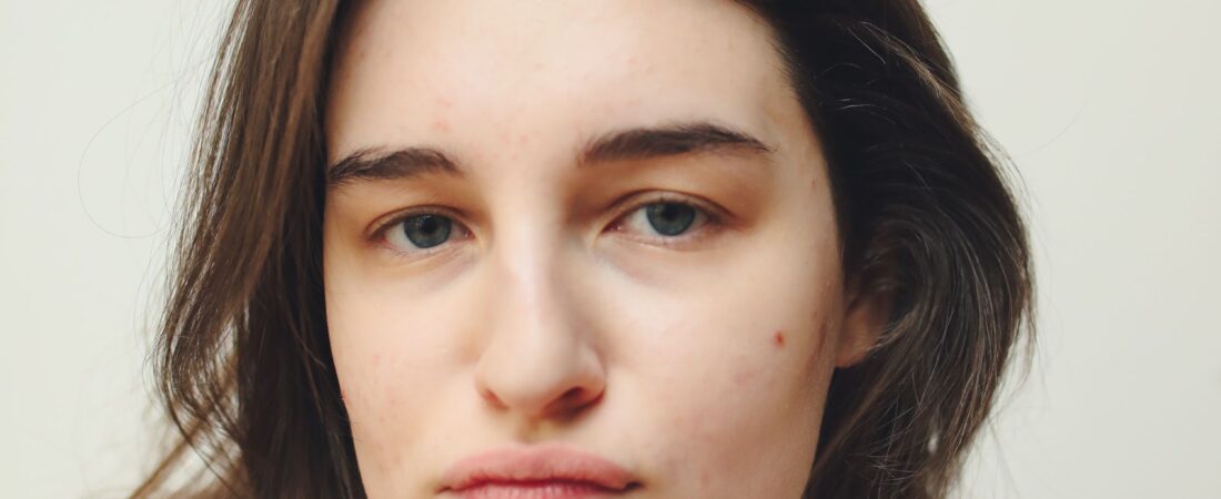 Manchas de Acne x Melasma: Como Diferenciar na Pele Madura