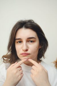 Manchas de Acne x Melasma: Como Diferenciar na Pele Madura