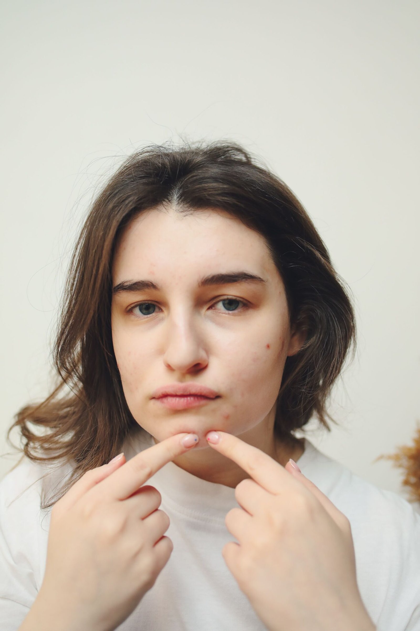 manchas de acne x melasma na pele madura