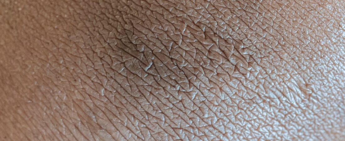 Textura da pele desidratada em close-up, mostrando ressecamento e descamação
