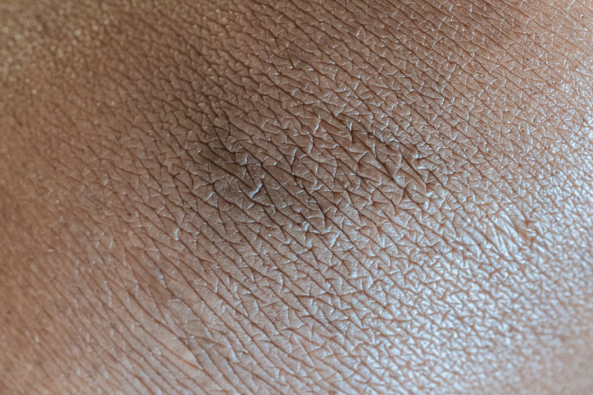 Textura da pele desidratada em close-up, mostrando ressecamento e descamação