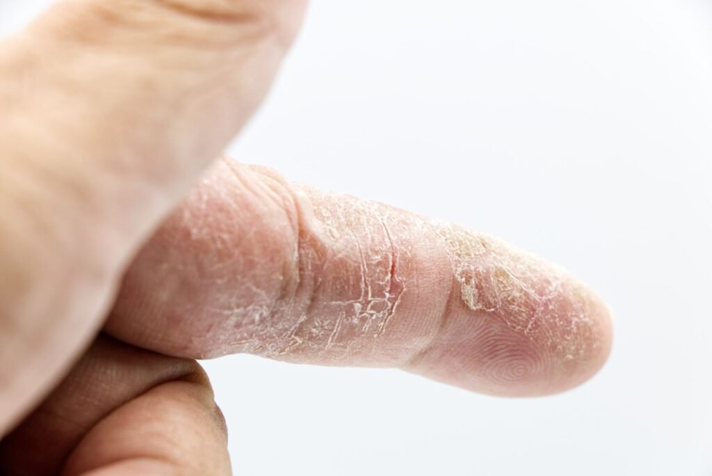 Eczema nas mãos: pele do dedo seca, descamando e rachada