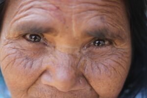 Hiperplasia sebácea: o que são as bolinhas amarelas no rosto