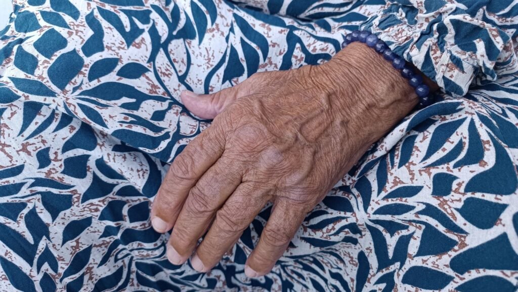 Pele fina no dorso da mão de mulher madura, local comum de manchas roxas