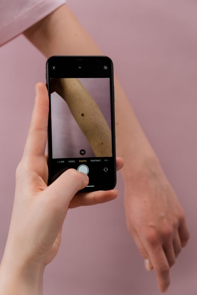 Pinta perigosa: foto com o celular para acompanhar a pinta no autoexame