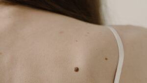Pinta perigosa: como reconhecer os sinais com a regra ABCDE