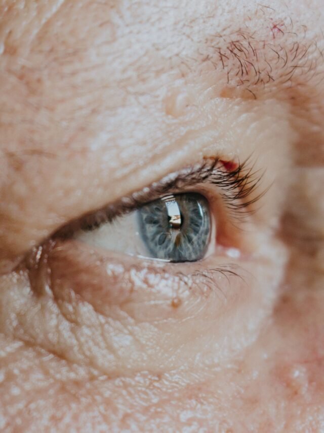 Siringoma embaixo dos olhos? Não tire com agulha