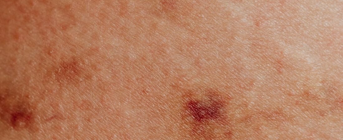 Urticária: 7 dicas da AAD para aliviar a coceira em casa