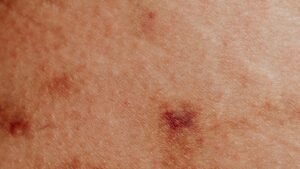 Urticária: 7 dicas da AAD para aliviar a coceira em casa