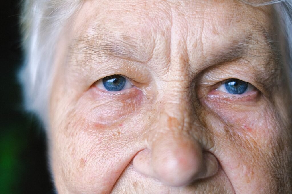 Xantelasma: área dos olhos de mulher madura